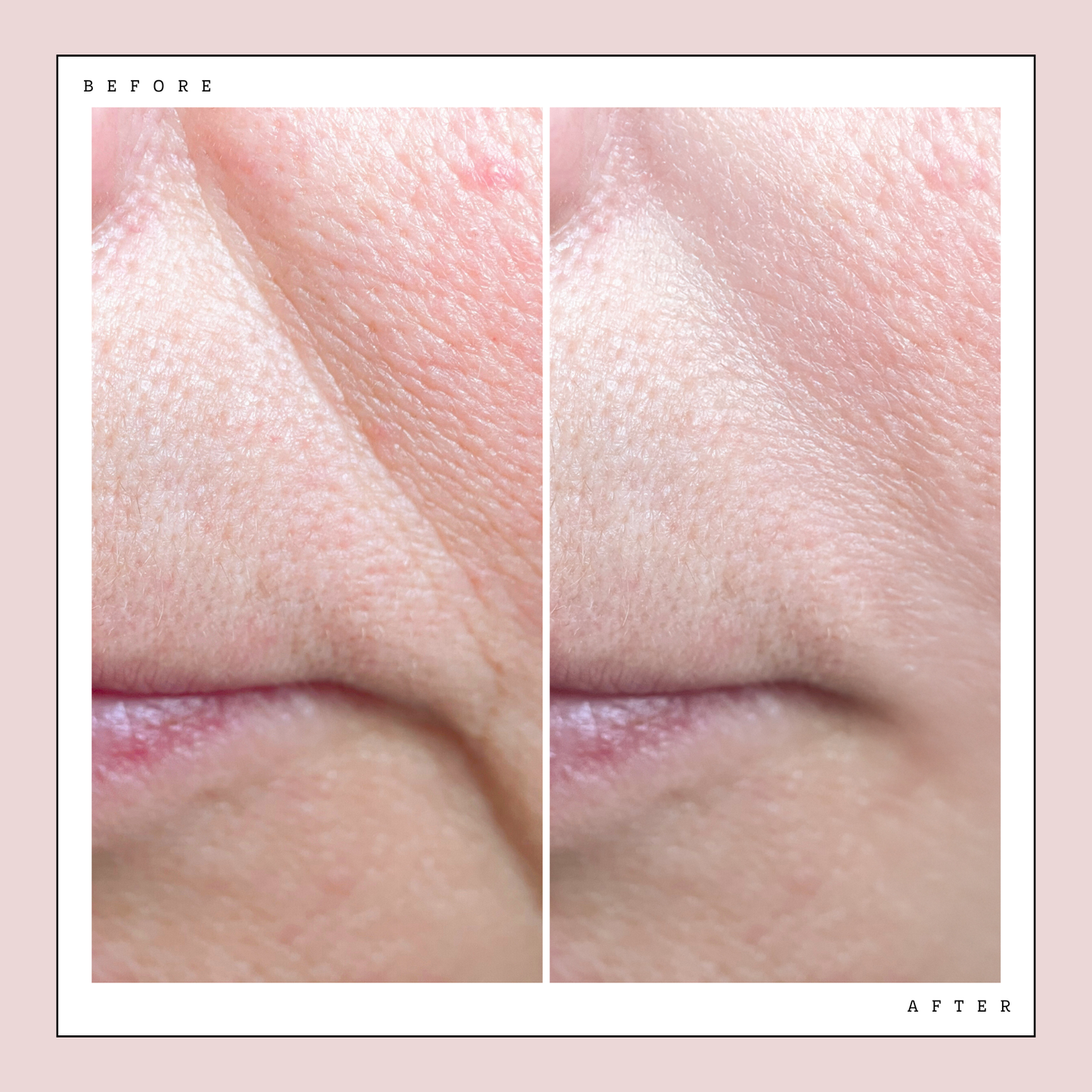 Before and after photo of wrinkles and fine lines improved after 6 weeks of using Glow LED Mask Pro. Wrinkles on corner of the mouth reduced and improved.