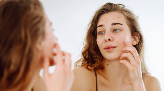 A woman with acne skin looking herself in the mirror| LED facial mak NZ | Skincare device NZ 