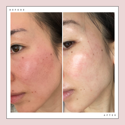 Before and after photo of using Glow LED Mask Pro or 4 weeks. redness reduced and ski barrier improved 