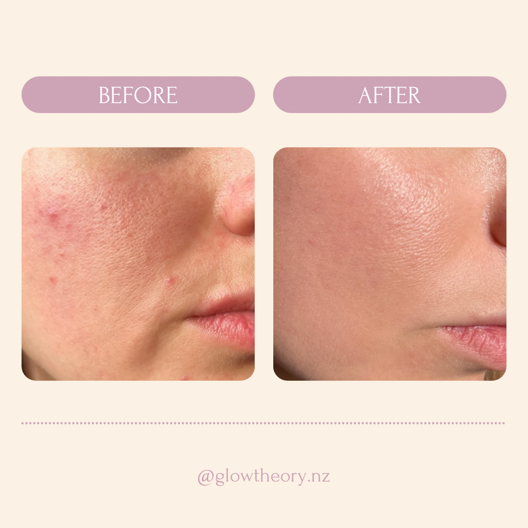 Glow LED Mask Pro | LED Red Light Therapy Face Mask NZ | Glow Theory | LED Facial Mask Results | Best LED Mask acne NZ