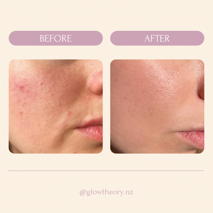 Glow LED Mask Pro | LED Red Light Therapy Face Mask NZ | Glow Theory | LED Facial Mask Results | Best LED Mask acne NZ