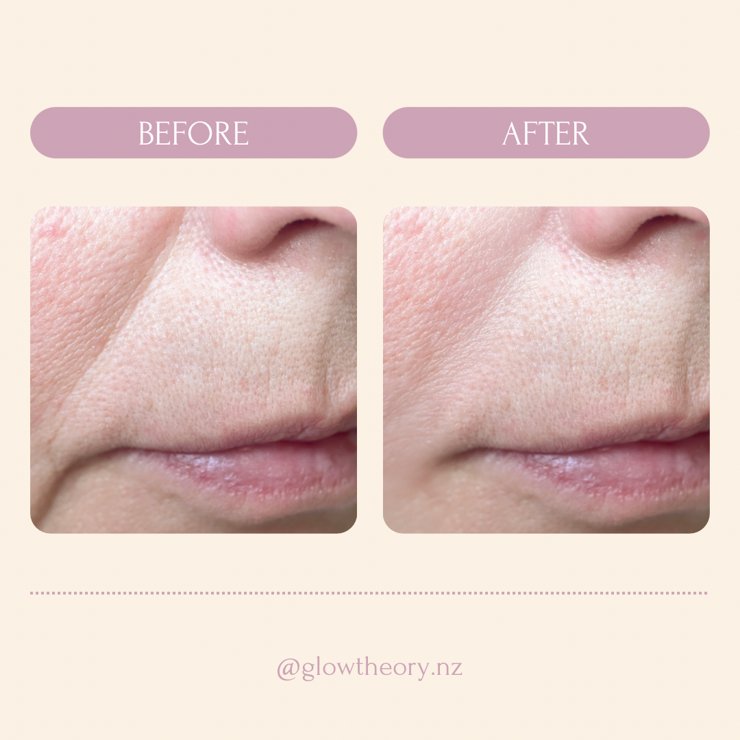 Glow LED Mask Pro | LED Red Light Therapy Face Mask NZ | Glow Theory | Shop LED Facial Mask Before & After| Best LED Mask acne NZ